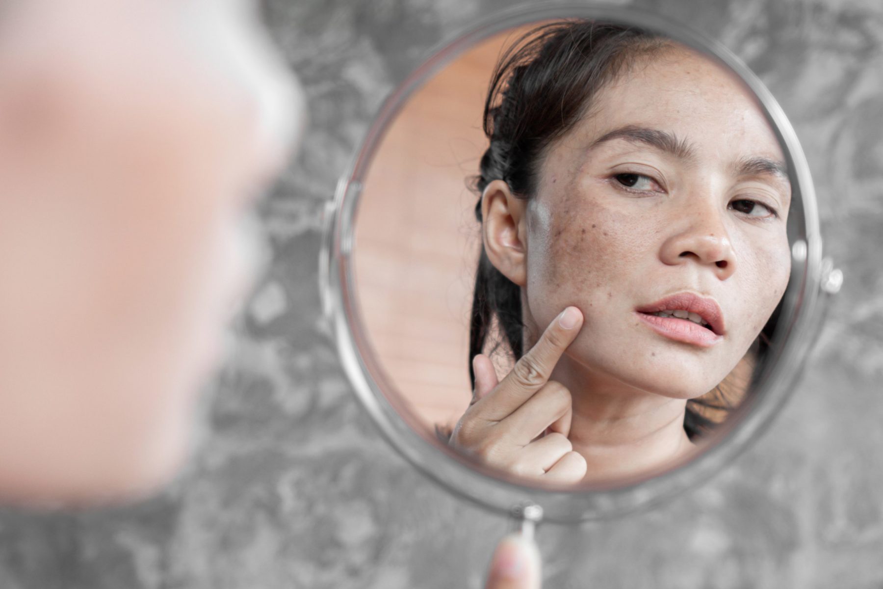 ¿Qué es la pigmentación en la piel y cómo prevenirla?